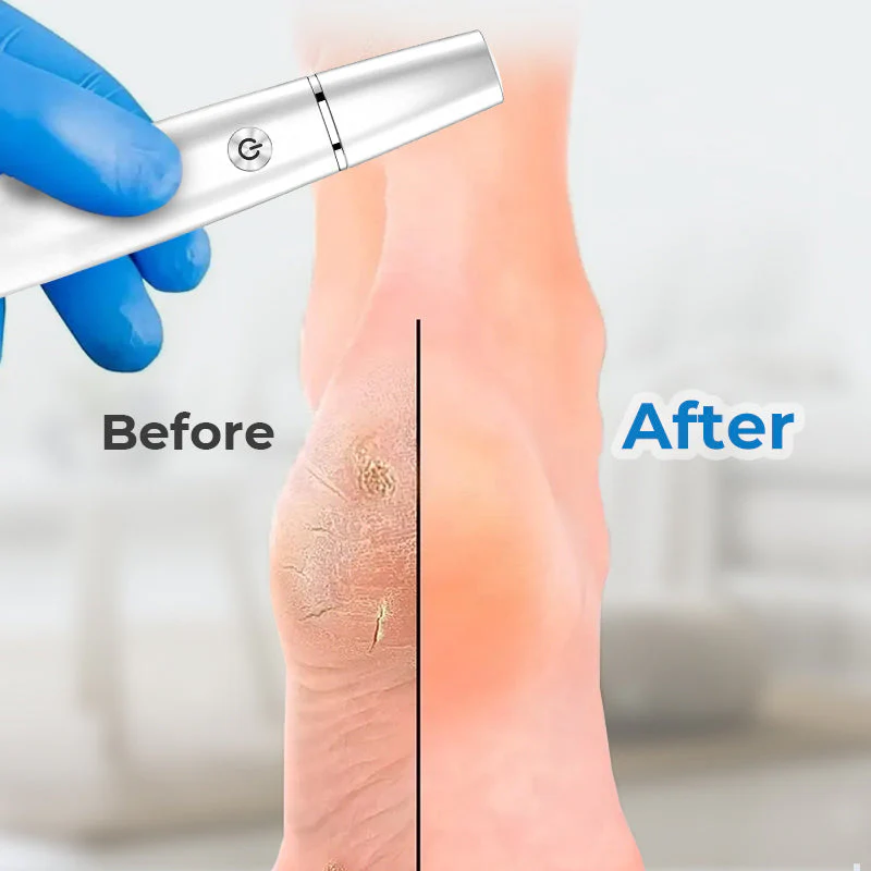 🔥Electric Feet Callus Remover⚡ - Image 4