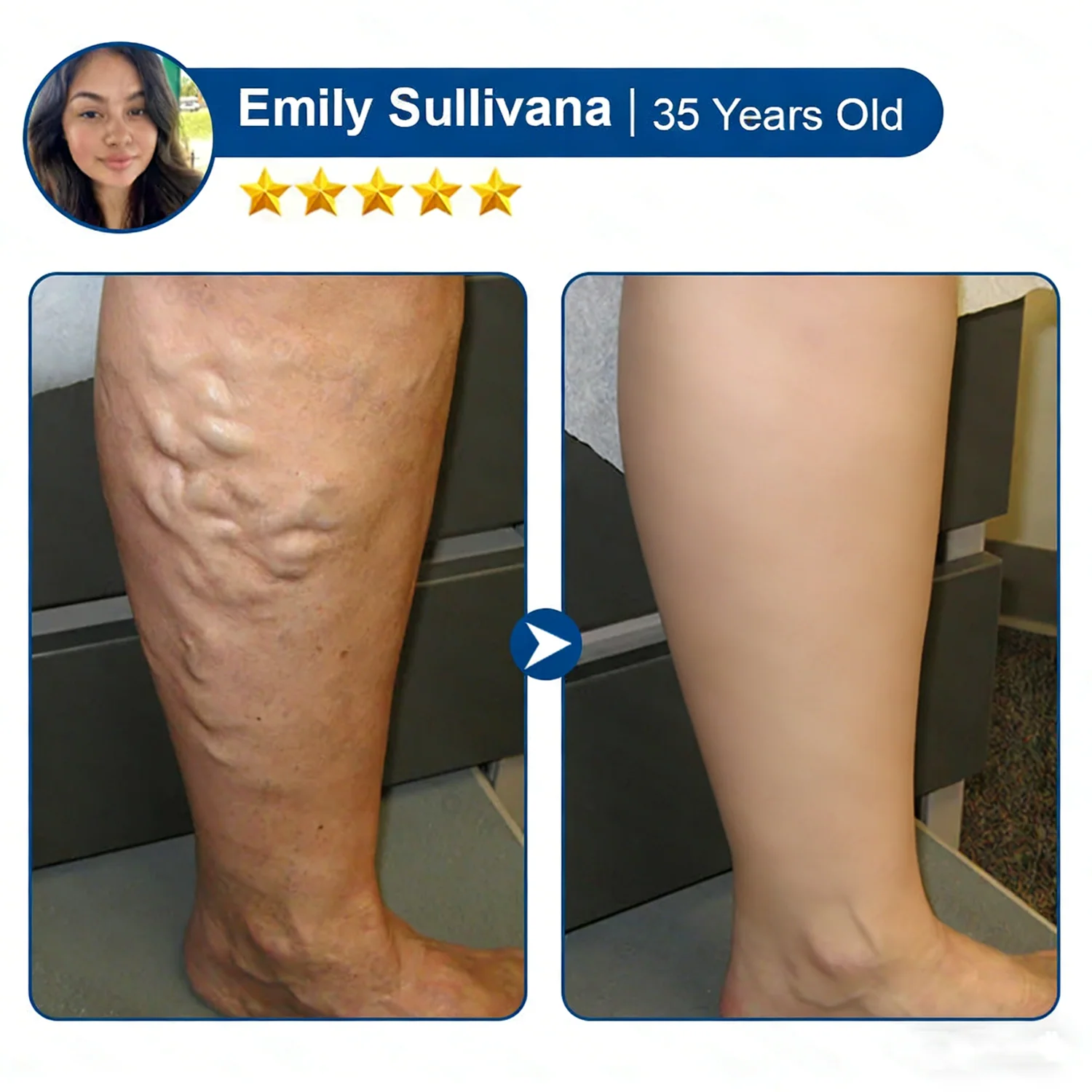 Vein ContourMicroneedle Patch with AdvancedDiosmin & Hesperidin Delivery 🌿 7-Day Visible Results for VaricoseVeins - Image 12